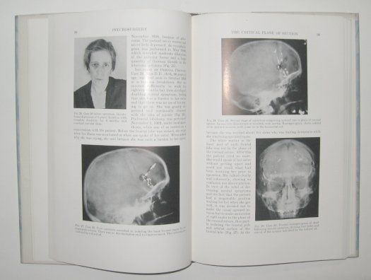 Freeman Psychosurgery Prefrontal Lobotomy 1942 1st Ed